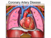 Coronary_Artery_Disease