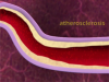 Peripheral_Arterial_Disease